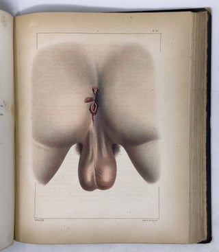 Illustrations of syphilitic disease. . . with the addition of a history of syphilis, and a complete bibliography and formulary of remedies. . . With Fifty Large Quarto Plates comprising one hundred and seventeen beautifully colored illustrations