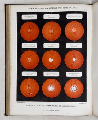 Atlas d'ophthalmoscopie médicale et de cérébroscopie montrant chez l'homme et chez les animaux les lésions du nerf optique, de la rétine et de la choroïde produites par les maladies du cerveau, par les maladies de la moelle épinère et par les maladies constitutionelles et humorales. . .