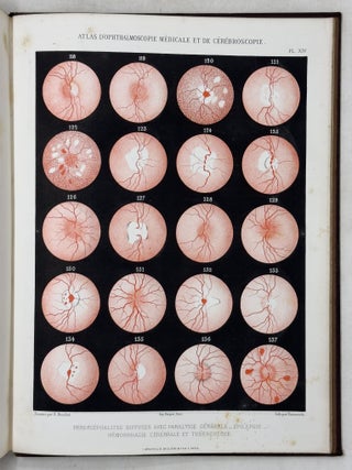 Atlas d'ophthalmoscopie m&eacute;dicale et de c&eacute;r&eacute;broscopie montrant chez l'homme et chez les animaux les l&eacute;sions du nerf optique, de la r&eacute;tine et de la choro&iuml;de produites par les maladies du cerveau, par les maladies de la moelle &eacute;pin&egrave;re et par les maladies constitutionelles et humorales. . .